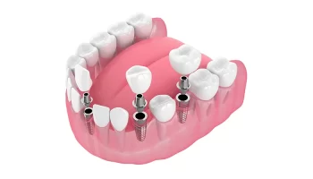 How All-On-4-Dental Implants Are the Right Option for You?
