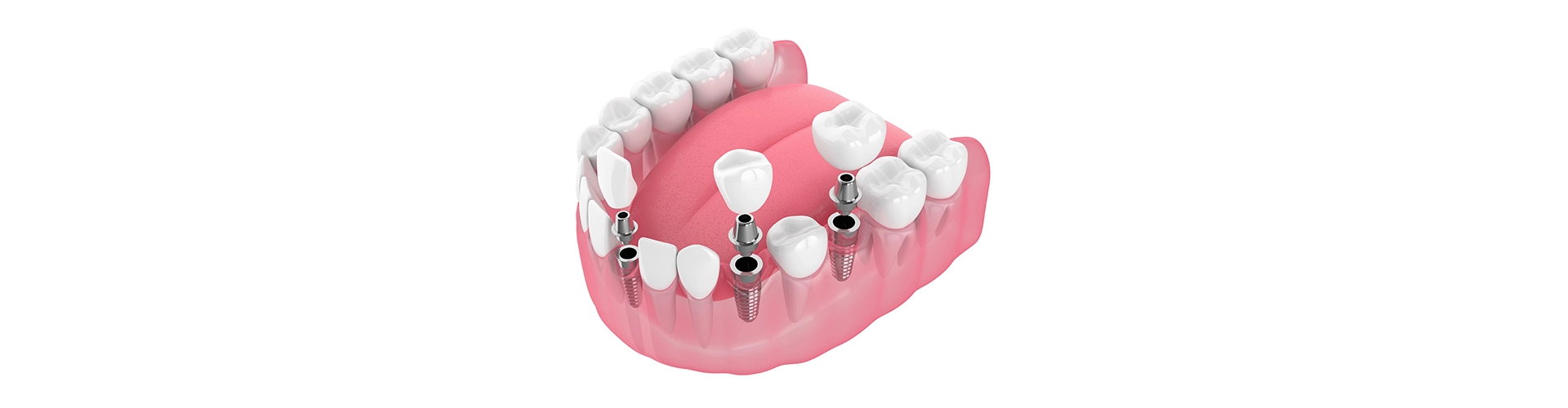 How All-On-4-Dental Implants Are the Right Option for You?