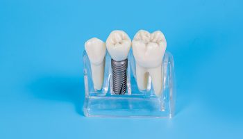 Dental Implants Failure Symptoms and Reasons for Implant Failure